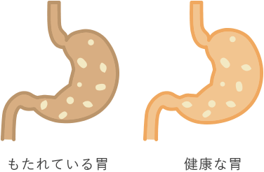 もたれている胃 健康な胃