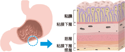 スキルス 胃がん 初期 症状