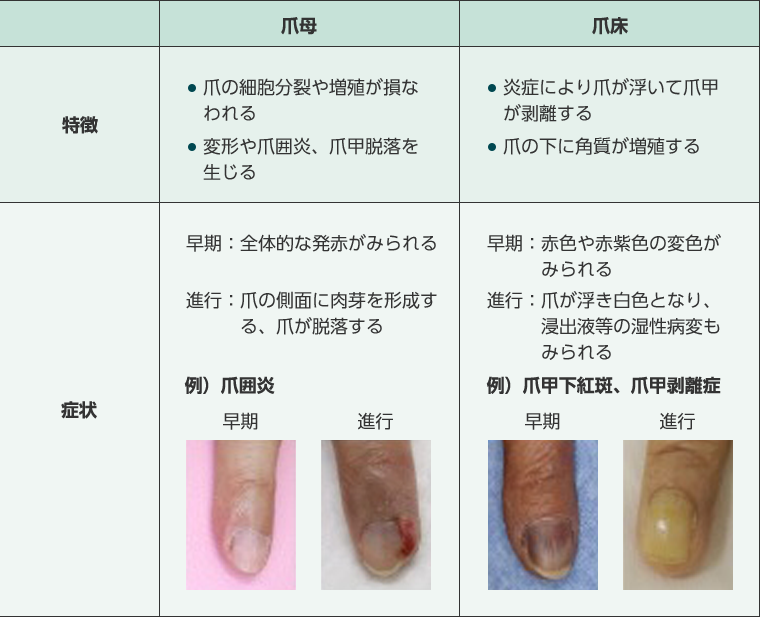 リトゴビ(フチバチニブ)による爪障害とケア方法 - 大鵬薬品