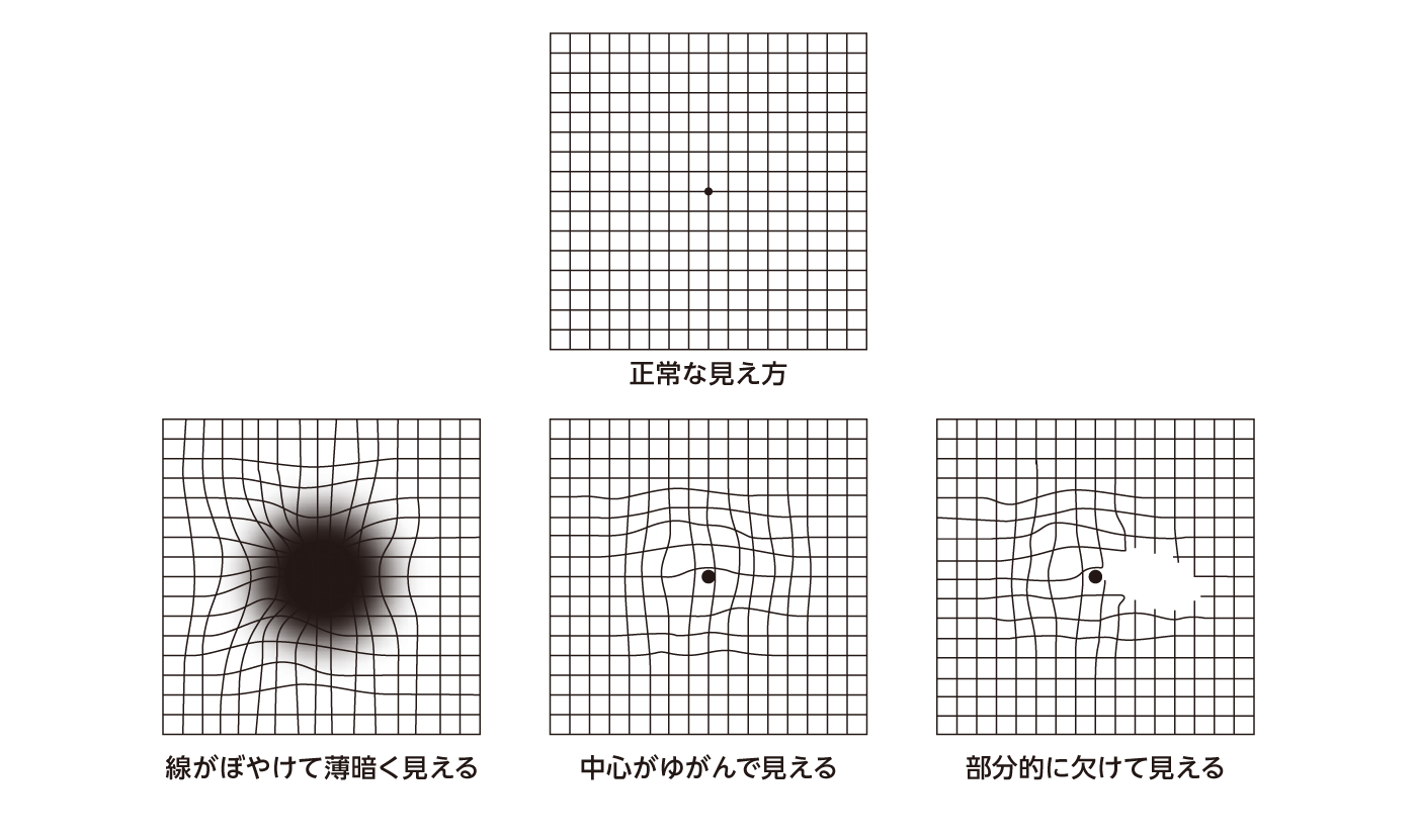 目の症状のセルフチェック