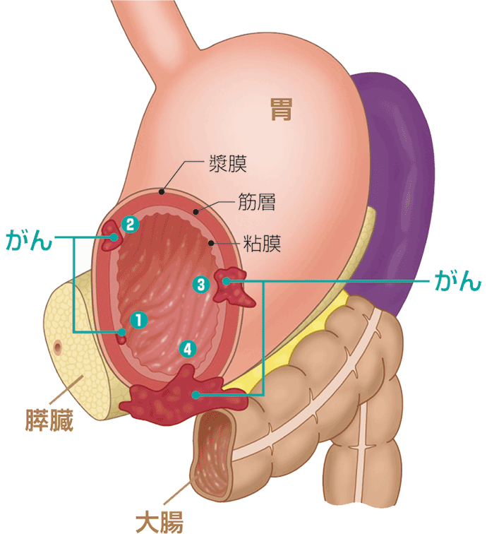 胃がんの説明図