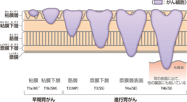 早期胃がんと進行胃がんの説明図