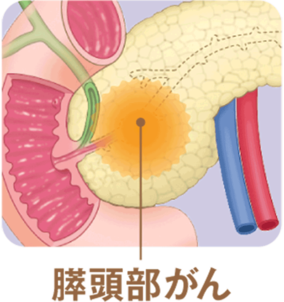 膵頭部がん