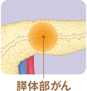 膵体部がん