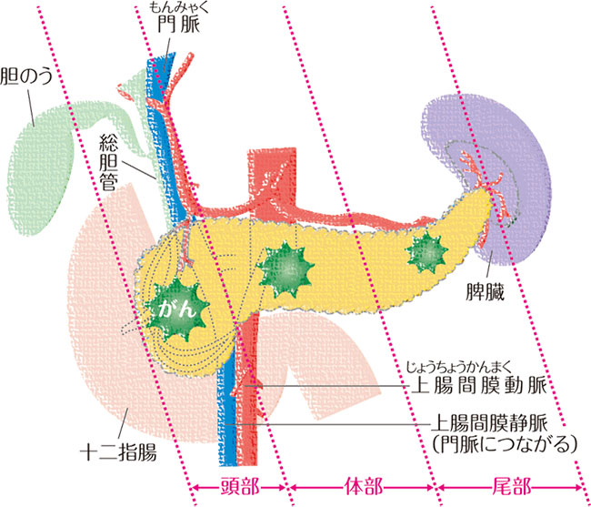 膵がんの説明図