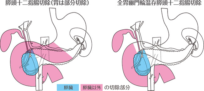 膵頭十二指腸切除の説明図