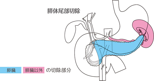 膵体尾部切除の説明図