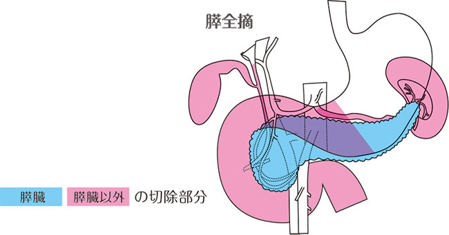 膵全摘の説明図